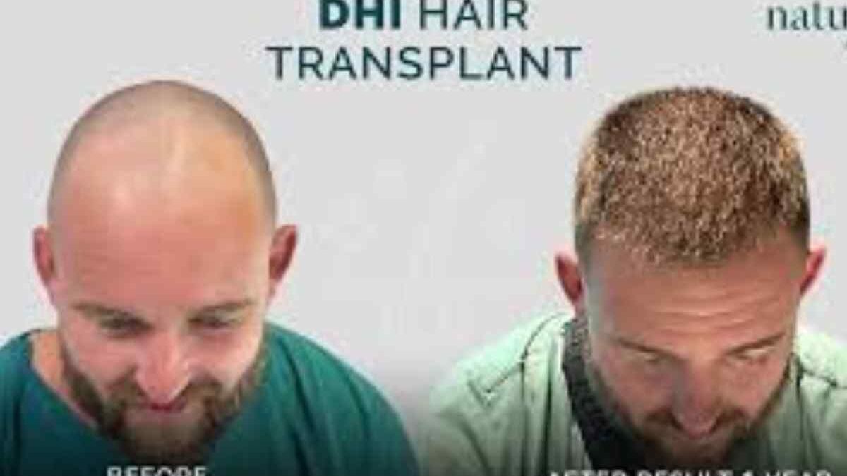 Hair Transplant Write for Us