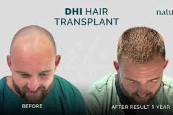 Hair Transplant